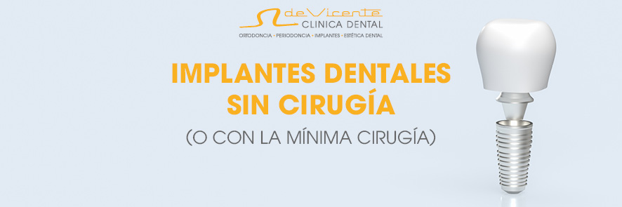 Implante dental en Granada en Clínica De Vicente Dental