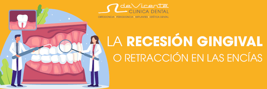 tratamiento de la recesión gingival en Granada o de la retracción de las encías