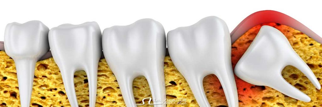 imagen de apiñamiento dental que se corrige con tratamiento de ortodoncia dental en Granada