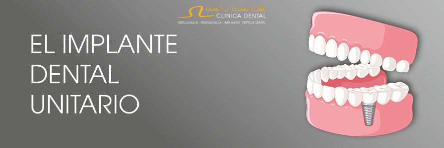 Implantes dentales en Granada en Clínica De Vicente Dental