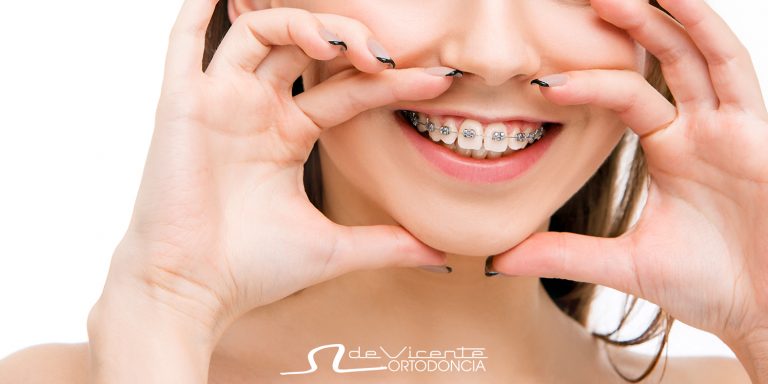 aparato de ortodoncia o brackets de tratamiento de ortodoncia en Granada para adolescentes