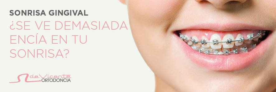 alineadores Invisalign en Granada en la clínica dental especialista con más de 20 años de experiencia en Invisalign